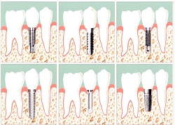 Implantes Dentales en Medellin
